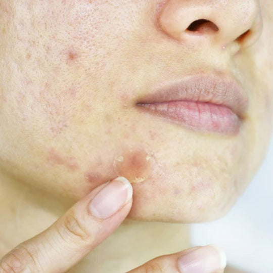 Skin Discoloration: Causes, Symptoms and Treatment